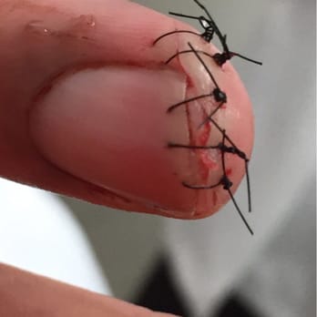 Medworks - A closeup of the stitches. The talented Dr. put the stitches through my fingernail. I didn't have to lose my fingernail. - Doctors Near Me - Joliet, Illinois Medworks - A closeup of the stitches. The talented Dr. put the stitches through my fingernail. I didn't have to lose my fingernail. - Doctors Near Me - Joliet, Illinois