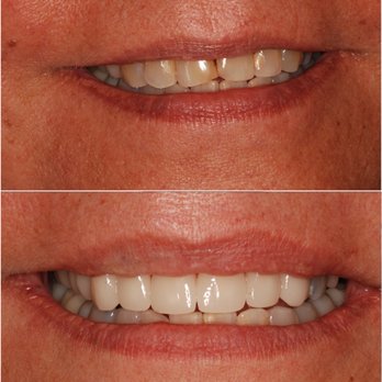 Becker Dental - All-Porcelain veneers/crowns completed in 1 visit without a "gooey" impression. - General Dentistry Near Me - Manteca, California Becker Dental - All-Porcelain veneers/crowns completed in 1 visit without a "gooey" impression. - General Dentistry Near Me - Manteca, California