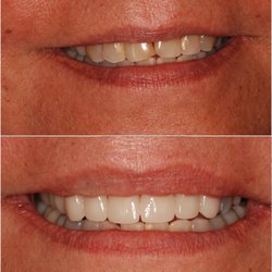 Becker Dental - All-Porcelain veneers/crowns completed in 1 visit without a "gooey" impression.
