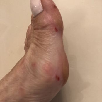 Spatique Nails - Cuts on foot from bad Pedicure! - Nail Salons Near Me - Boynton Beach, Florida