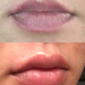 Chase Lay, MD - Top: Before Bottom: After Juvederm lip fill - Medical Spas Near Me - San Jose, California