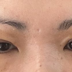 2301 Plastic Surgery - After with stitches