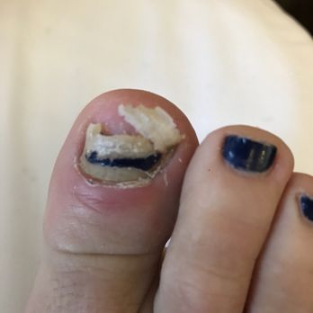 Austin Foot and Ankle Specialists - Before - Podiatrists Near Me - Austin, Texas