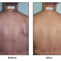 Happel Laser Spa - Before and after laser hair removal