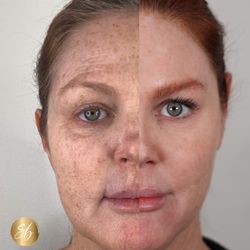 Soul And Beauty Medx - This patient came to us with decades of sun damage. Her picture on the right is after a series of 3 laser treatments with BBL/Moxi