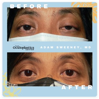Adam Sweeney, MD - Before and after upper eyelid ptosis repair (lid lift) - Ophthalmologists Near Me - Honolulu, Hawaii Adam Sweeney, MD - Before and after upper eyelid ptosis repair (lid lift) - Ophthalmologists Near Me - Honolulu, Hawaii