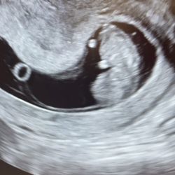 Dragon Acupuncture & Herb Center - 9-week healthy fetus!