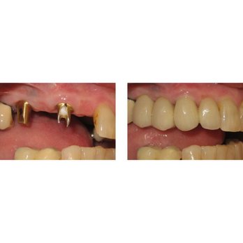 Washington State Prosthodontics - Cosmetic Dentists Near Me - Bellevue, Washington Washington State Prosthodontics - Cosmetic Dentists Near Me - Bellevue, Washington