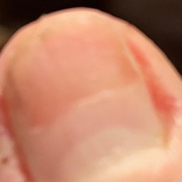 Thumb nail damaged by sanding device Thumb nail damaged by sanding device