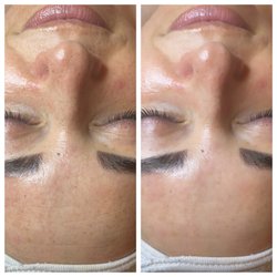Virtue Holistic Skin Studio  - Rejuvenation Facial - Before and After