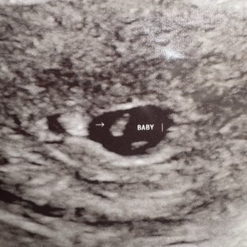 SonoMommy - Picture of our first ultrasound! - Ultrasound Imaging Centers Near Me - Hemet, California SonoMommy - Picture of our first ultrasound! - Ultrasound Imaging Centers Near Me - Hemet, California