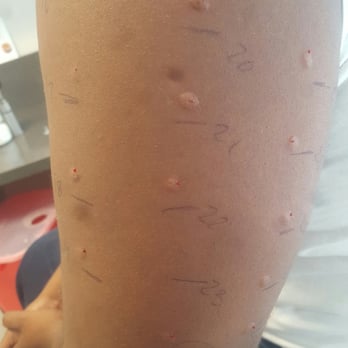 Allergy & Asthma Center - Internal allergy testing - Allergists Near Me - Greenbelt, Maryland Allergy & Asthma Center - Internal allergy testing - Allergists Near Me - Greenbelt, Maryland