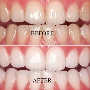 Shanabo Dental Clinic - Shanabo Dental offers whitening treatments to achieve that pearly white smile! - General Dentistry Near Me - Baldwin Park, California Shanabo Dental Clinic - Shanabo Dental offers whitening treatments to achieve that pearly white smile! - General Dentistry Near Me - Baldwin Park, California