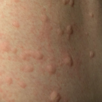 La Sabrosa Taqueria - Hives after eating the food. - Mexican Near Me - Bothell, Washington