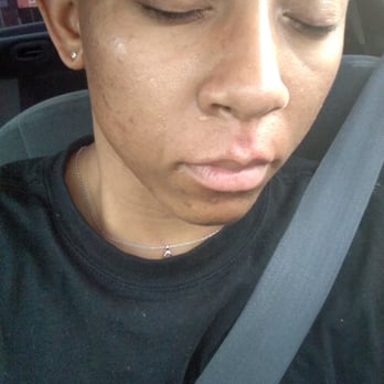 Sassy Nail Spa - Face Bright Red with Wax left on my face!!! Chin hair still in TACT!! What the hell!!? - Nail Salons Near Me - Fayetteville, North Carolina