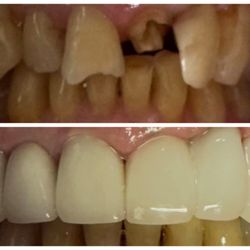 Pinnacle Hills Dental Group - before and one week after