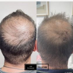 Follicure hair therapy