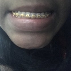 Orthodontic Care of Georgia - Atlanta - I went from white gold braces to yellow gold. I'm so  love!!!!