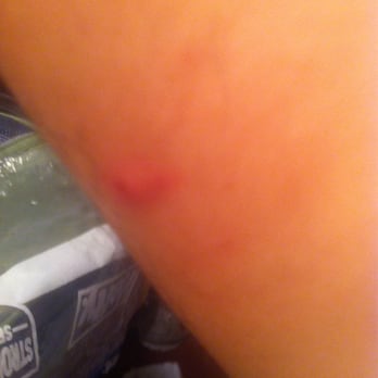 Chelsea Inn - Bed bug bite - Hotels Near Me - San Francisco, California Chelsea Inn - Bed bug bite - Hotels Near Me - San Francisco, California