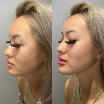 Windward Med Spa - The perfect lip and chin filler - Medical Spas Near Me - Alpharetta, Georgia Windward Med Spa - The perfect lip and chin filler - Medical Spas Near Me - Alpharetta, Georgia