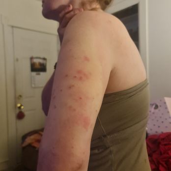 Vision Management & Maintenance - Bed bug bites on a friend she stayed with me for a week lost her job because they thought she was a heroin addict - General Contractors Near Me - Bridgeport, Connecticut Vision Management & Maintenance - Bed bug bites on a friend she stayed with me for a week lost her job because they thought she was a heroin addict - General Contractors Near Me - Bridgeport, Connecticut