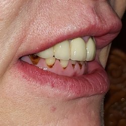 Advanta Dental - buck teeth!  I am embarrassed over my appearance.  Depressed and disgusted over Rahm's negligence.  No money to fix.