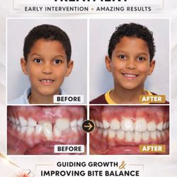 Piero Palacios, MDS DDS - Gentle Braces - Phase 1 treatment