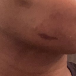 Burn on my chin Burn on my chin