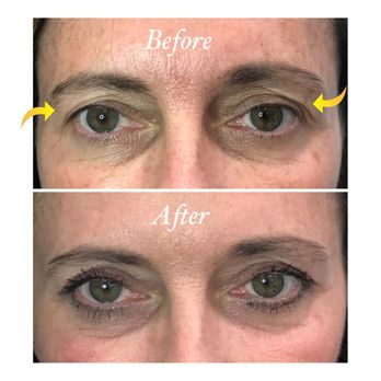 Beautiful Med Spa - pro-fractional laser resurfacing for hooded eyelids - Medical Spas Near Me - Las Vegas, Nevada Beautiful Med Spa - pro-fractional laser resurfacing for hooded eyelids - Medical Spas Near Me - Las Vegas, Nevada