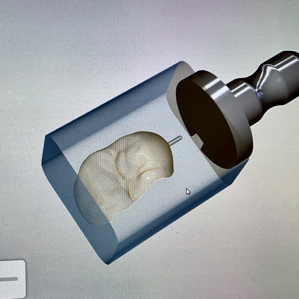 Lance I Teramoto, DDS - My new custom porcelain crown being designed by Dr. Lance. - General Dentistry Near Me - Honolulu, Hawaii Lance I Teramoto, DDS - My new custom porcelain crown being designed by Dr. Lance. - General Dentistry Near Me - Honolulu, Hawaii