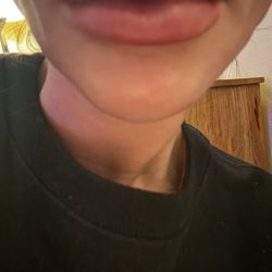 Royal Med Spa - They botched my face, won't call Me back and I am So Sad never go To them