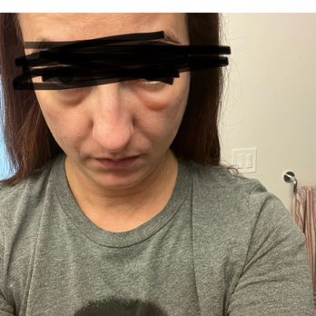 David C. Mabrie, MD - This is me in August 2022 , 14 months post my first injection - Cosmetic Surgeons Near Me - San Francisco, California
