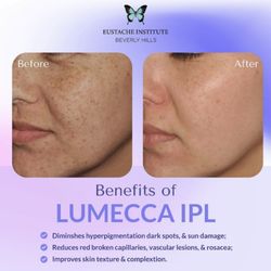 Lumecca IPL