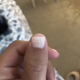 Damage to nail bed Damage to nail bed