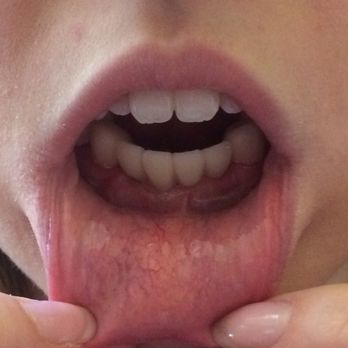 American Dental Excellence - Can you tell which teeth are the bridge? - Cosmetic Dentists Near Me - Limerick, Pennsylvania American Dental Excellence - Can you tell which teeth are the bridge? - Cosmetic Dentists Near Me - Limerick, Pennsylvania