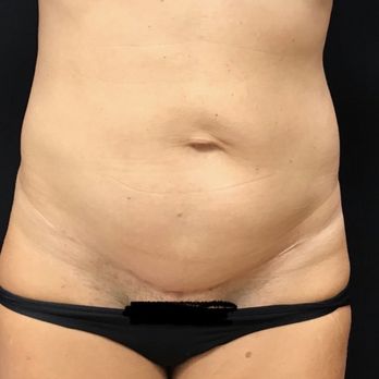 Honolulu Plastic Surgery - Would anyone believe this is AFTER A TUMMY TUCK!??? Thanks Dr.Wong!!!! - Plastic Surgeons Near Me - Honolulu, Hawaii Honolulu Plastic Surgery - Would anyone believe this is AFTER A TUMMY TUCK!??? Thanks Dr.Wong!!!! - Plastic Surgeons Near Me - Honolulu, Hawaii