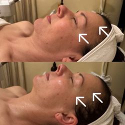 Skin Rejuvenation - Before & after custom facial