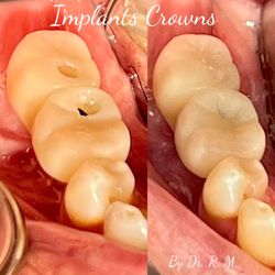 Rubi Montejano - Implants the best choice to replace missing teeth!