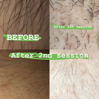 SEV Laser - After 2 sessions. - Laser Hair Removal Near Me - Los Gatos, California SEV Laser - After 2 sessions. - Laser Hair Removal Near Me - Los Gatos, California