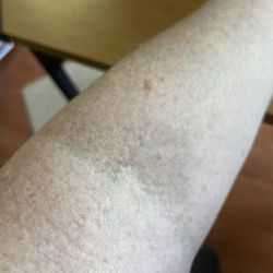 Quest Diagnostics - This is my arm 2 days later. Very tiny spot. No bruise at all and she took 5 tubes of blood.