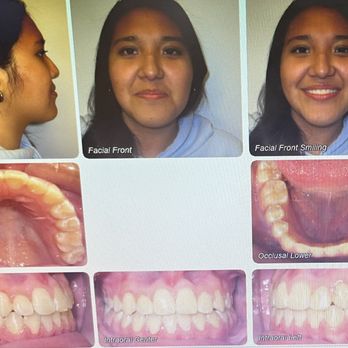 iSmiles Braces - Orthodontists Near Me - Corona, California