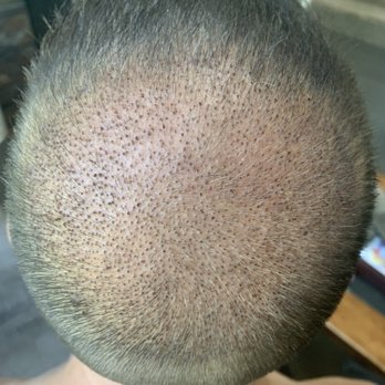 RESTORE Hair - Day 4 - Hair Loss Centers Near Me - Oak Brook, Illinois RESTORE Hair - Day 4 - Hair Loss Centers Near Me - Oak Brook, Illinois