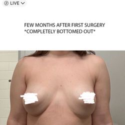 Michael A Fiorillo, MD - Reflections Medical - Few months after first surgery - implants completely bottomed out