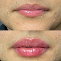 Magnolia Medical Aesthetics - Our beautiful patient before and after one session of corrective lip filler with Restylane Kysse. Injector: Nurse Dasha
