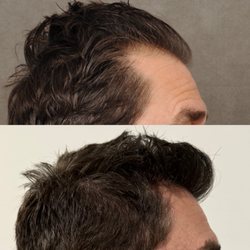 Beverly Hills Hair Group - Beautiful hairline and apexes reconstruction on our amazing patient.