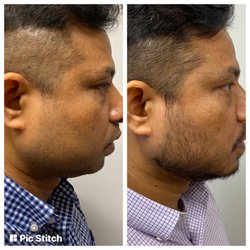 Anthony Farole, DMD - Cervicofacial Liposuction before and after