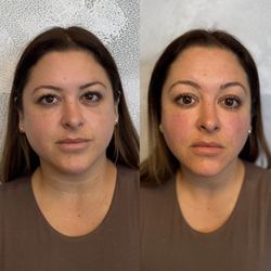 Just Injected - Sculptra before and after.