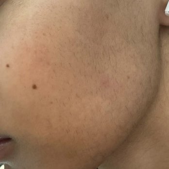 New Look Skin Center - My hair after they done 10 session of their laser removal - Medical Spas Near Me - Irvine, California