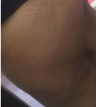 Perfections body sculpt - After Six Sessions Of Non Invasive Brazilian Buttlift. Reduce cellulite and dimples in smooth skin. There is no downtime and no pain. - Body Contouring Near Me - Rowlett, Texas Perfections body sculpt - After Six Sessions Of Non Invasive Brazilian Buttlift. Reduce cellulite and dimples in smooth skin. There is no downtime and no pain. - Body Contouring Near Me - Rowlett, Texas