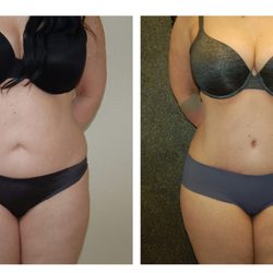 Rohit Jaiswal, MD - Atelier Plastic Surgery - Tummy tuck before and after